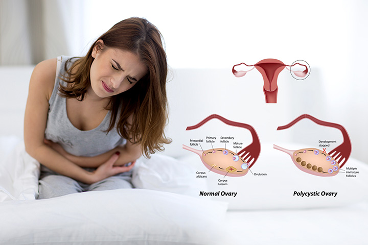polycystic-ovary-syndrome-neslazeno